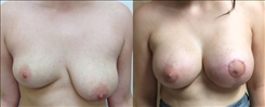 Breast Asymmetry Patient Before & After Photo 1