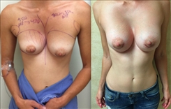 Breast Asymmetry Patient Before & After Photo 1
