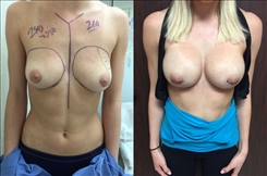 Breast Procedures Patient Before & After Photo 1