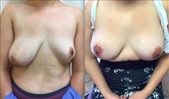 Breast Procedures Patient Before & After Photo 1