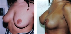 Breast Augmentation Patient Before & After Photo 1