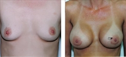 Breast Procedures Patient Before & After Photo 1