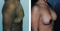 Breast Procedures Patient Before & After Photo 1