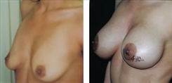 Breast Procedures Patient Before & After Photo 1