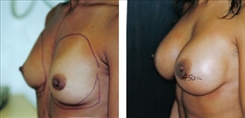 Breast Augmentation Patient Before & After Photo 1