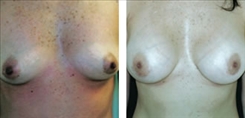 Breast Augmentation Patient Before & After Photo 1