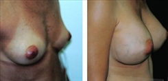 Breast Augmentation Patient Before & After Photo 1