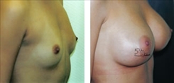 Breast Procedures Patient Before & After Photo 1