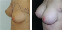 Breast Procedures Patient Before & After Photo 1