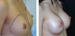 Breast Procedures Patient Before & After Photo 1