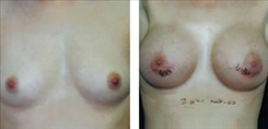 Breast Augmentation Patient Before & After Photo 1