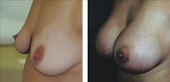 Breast Augmentation Patient Before & After Photo 1