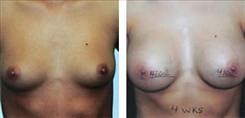 Breast Augmentation Patient Before & After Photo 1