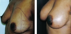 Breast Procedures Patient Before & After Photo 1