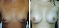 Breast Procedures Patient Before & After Photo 1