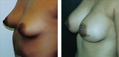 Breast Procedures Patient Before & After Photo 1