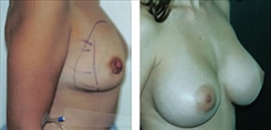 Breast Augmentation Patient Before & After Photo 1