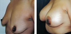 Breast Procedures Patient Before & After Photo 1