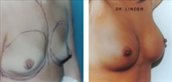 Breast Augmentation Patient Before & After Photo 1