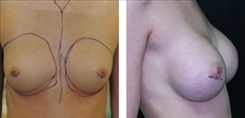 Breast Augmentation Patient Before & After Photo 1