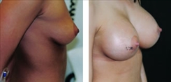 Breast Augmentation Patient Before & After Photo 1