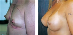 Breast Augmentation Patient Before & After Photo 1