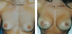 Breast Augmentation Patient Before & After Photo 1