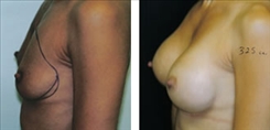 Breast Procedures Patient Before & After Photo 1