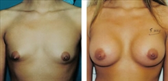 Breast Procedures Patient Before & After Photo 1