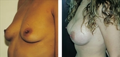 Breast Augmentation Patient Before & After Photo 1