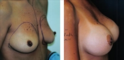 Breast Augmentation Patient Before & After Photo 1