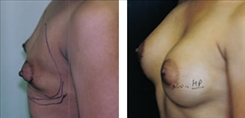 Breast Augmentation Patient Before & After Photo 1