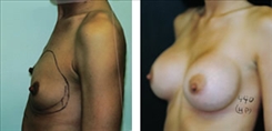 Breast Augmentation Patient Before & After Photo 1