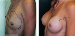 Breast Augmentation Patient Before & After Photo 1