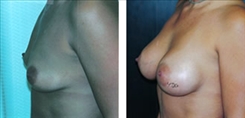 Breast Procedures Patient Before & After Photo 1