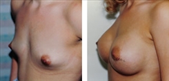 Breast Augmentation Patient Before & After Photo 1