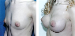 Breast Procedures Patient Before & After Photo 1