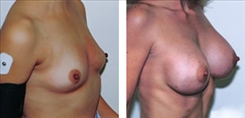 Breast Augmentation Patient Before & After Photo 1