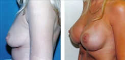 Breast Augmentation Patient Before & After Photo 1