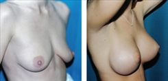 Breast Procedures Patient Before & After Photo 1