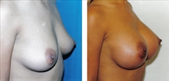 Breast Procedures Patient Before & After Photo 1