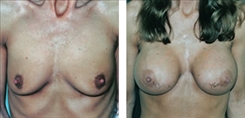 Breast Procedures Patient Before & After Photo 1