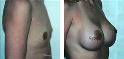 Breast Augmentation Patient Before & After Photo 1