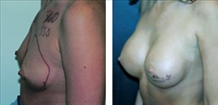 Breast Procedures Patient Before & After Photo 1