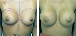 Breast Augmentation Patient Before & After Photo 1