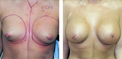 Breast Augmentation Patient Before & After Photo 1