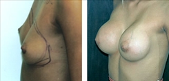 Breast Augmentation Patient Before & After Photo 1