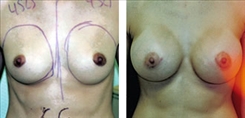 Breast Procedures Patient Before & After Photo 1