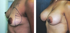 Breast Procedures Patient Before & After Photo 1