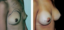 Breast Augmentation Patient Before & After Photo 1